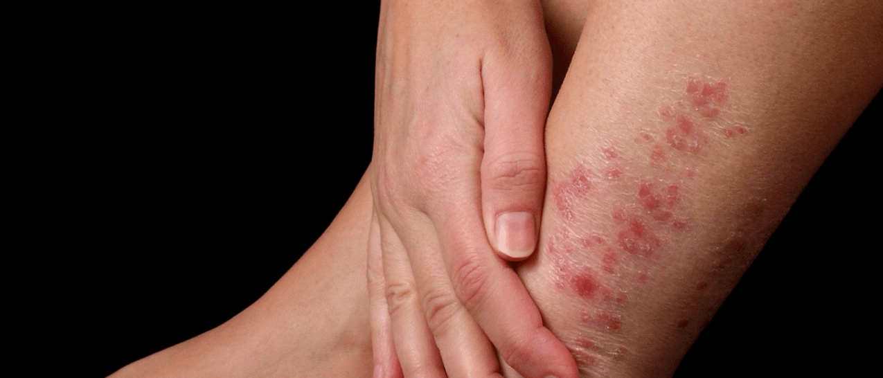Psoriazės plokštelės ant kojų odos