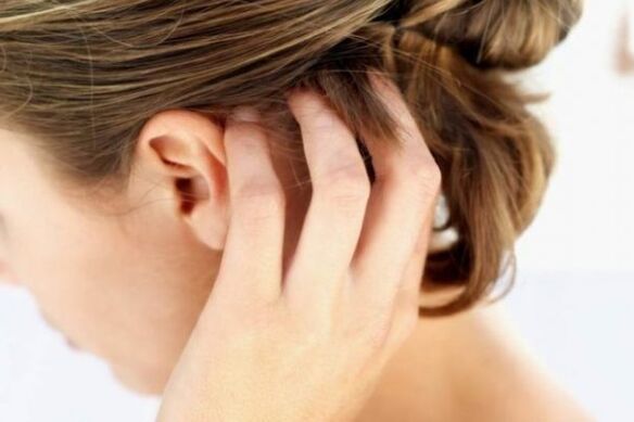 Nepakeliamas galvos odos niežėjimas yra psoriazės požymis ūminėje stadijoje